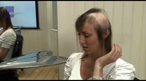 radiotherapy-side-effects-hair-loss