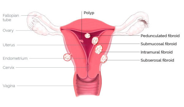 Causes-Of-Infertility-Endometriosis-And-Uterine-Fibroid