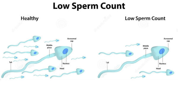 Causes-Of-Infertility-Low-Sperm-Count