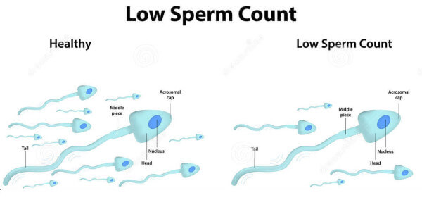 Anal stricture in infant