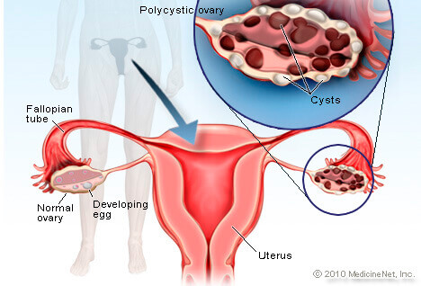 Causes-Of-Infertility-Polycystic-Ovarian-Syndrome