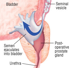 Causes-Of-Infertility-Retrograde-Ejaculation