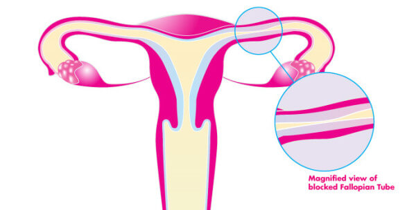 Causes-Of-Infertility-Tubal-Blockage