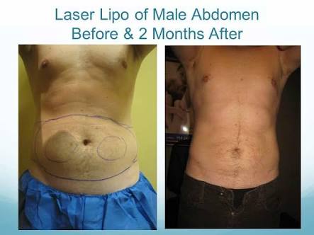 Laser-based-liposuction
