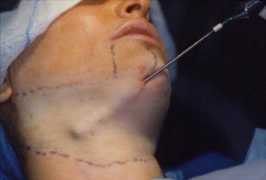 Neck-Liposuction 