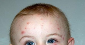 chicken-pox-scar-removal
