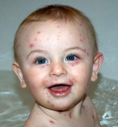Scar removal home remedies for chicken pox